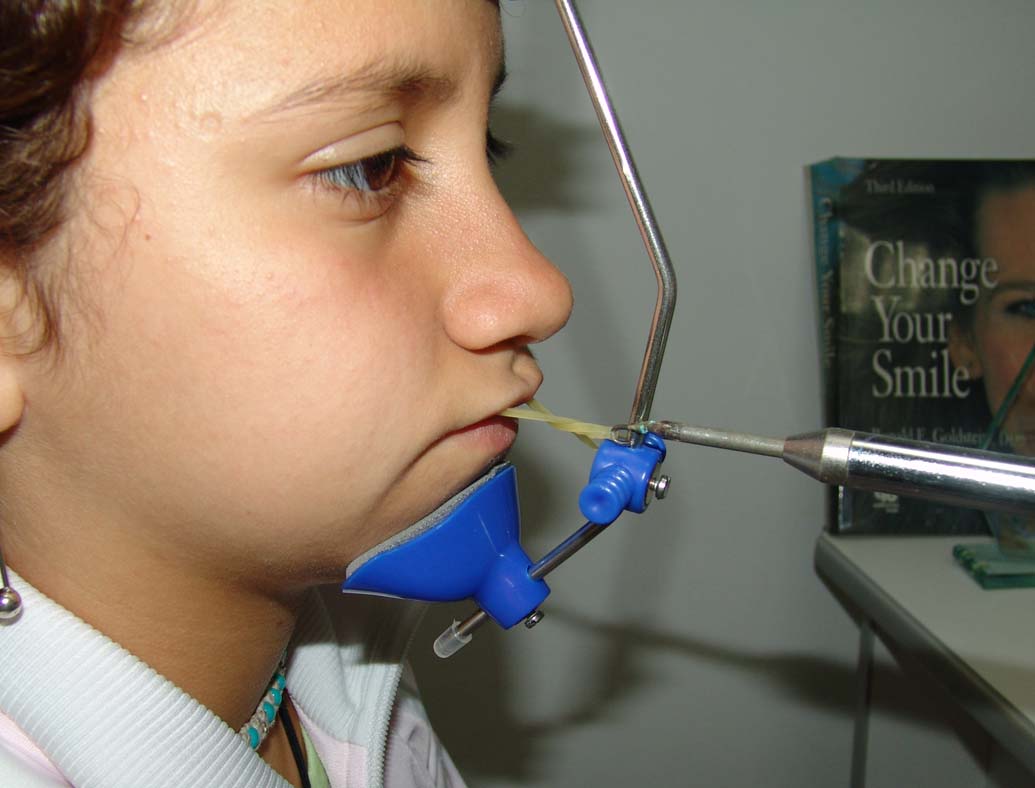 Crecimiento Y Desarrollo Craneofacial Aplicaci n Cl nica Wikiortodoncia