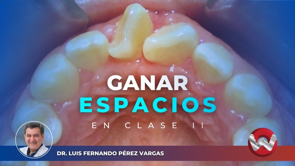Como crear espacios SIN EXTRACCIONES dentales en una clase II esquelética