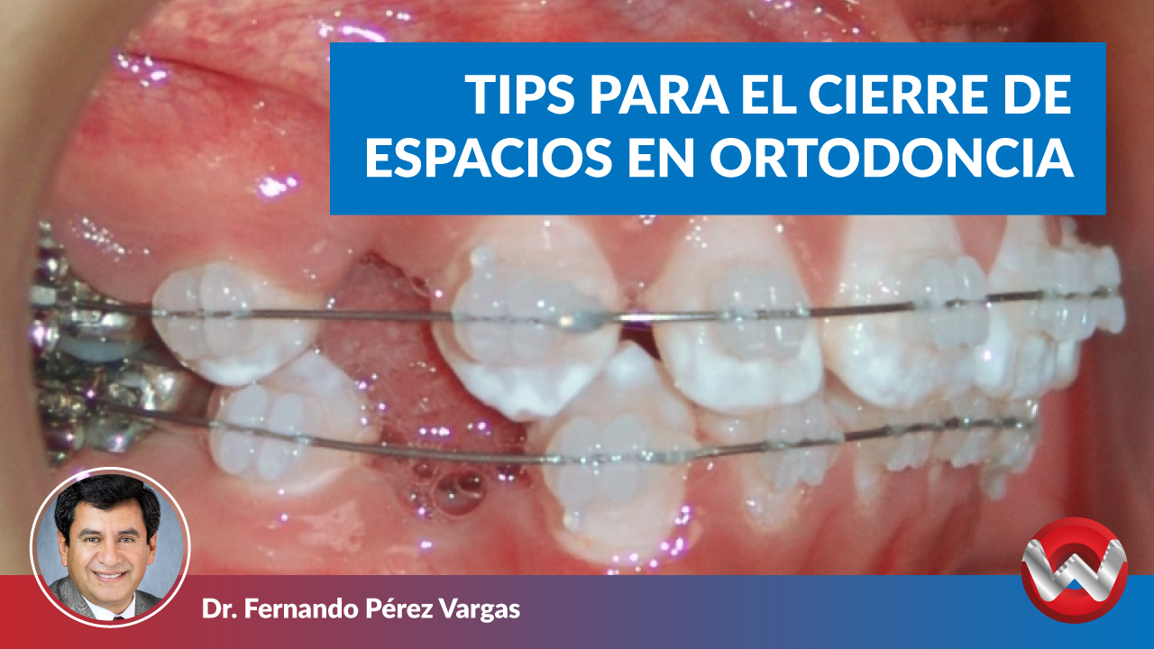Tips para el cierre de espacios en ortodoncia